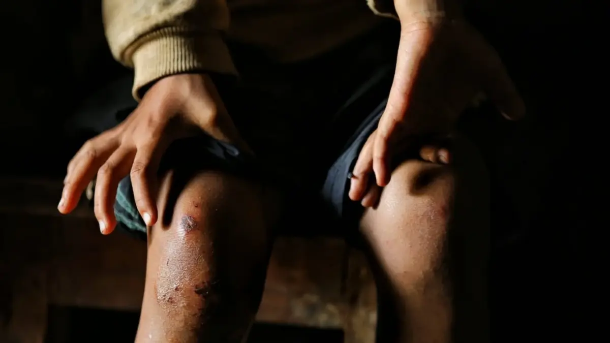 Kirti Tamang's injuries. Photo by Suman Nepali of Nepali Times. Used with permission.